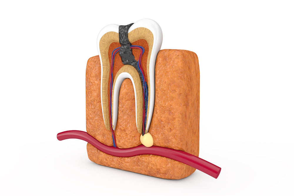  Endodonti (Kanal Tedavisi)