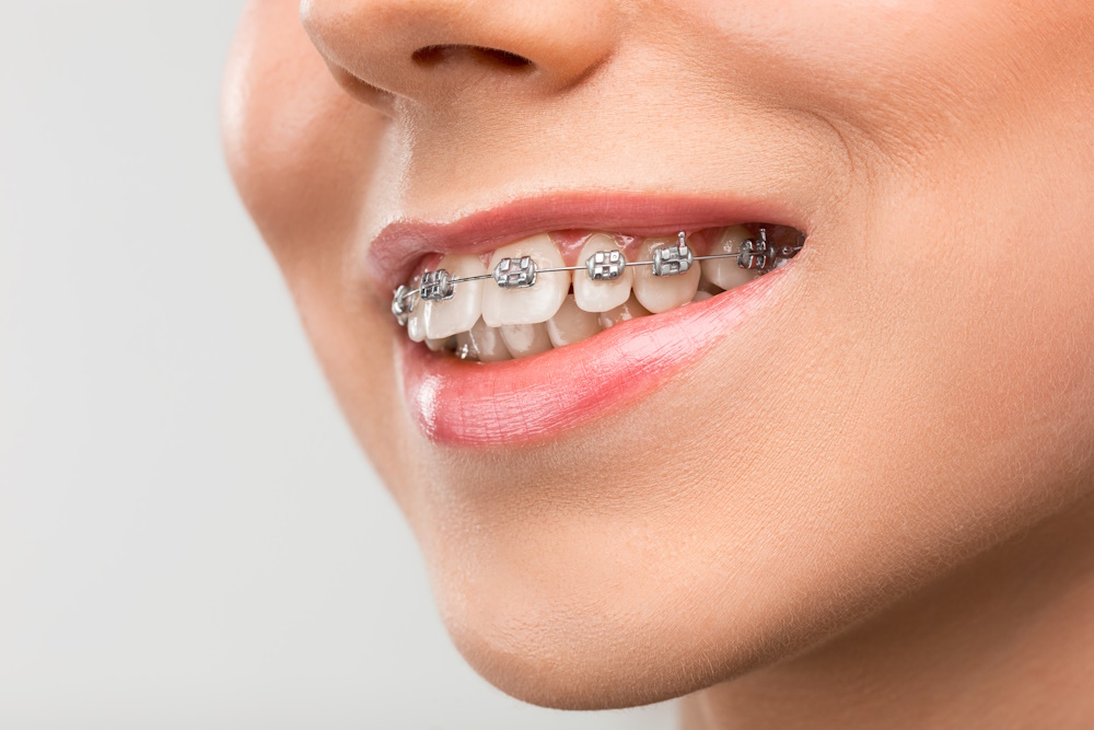  Ortodonti (Diş Teli)